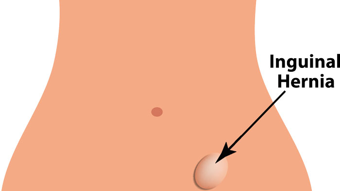 inguinal-hernia